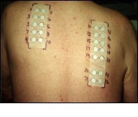 Allergy Testing - Patch Testing